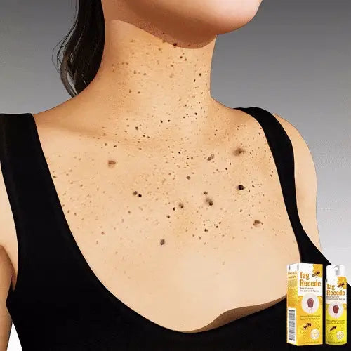 Tag Recede™: Spray Eliminador de Verrugas Instantáneo